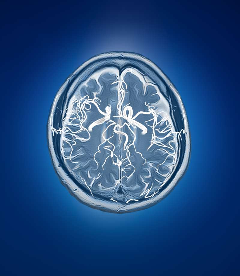 Blood vessel with human brain MRI
